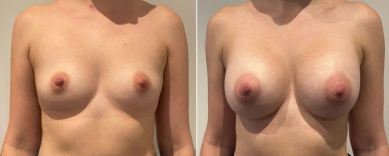 Augmentation mammoplasty surgery, before and after 220, front view, BPCS Brisbane