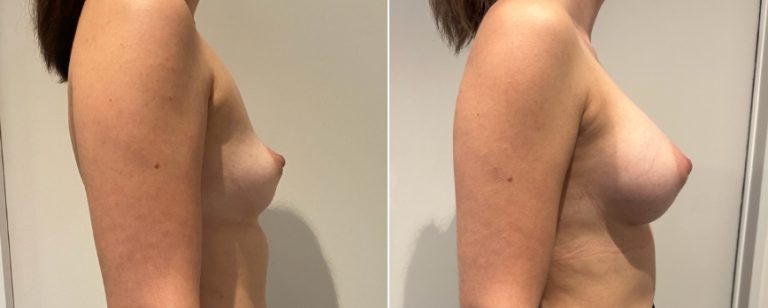 Augmentation mammoplasty surgery, before and after 220, side view, BPCS Brisbane
