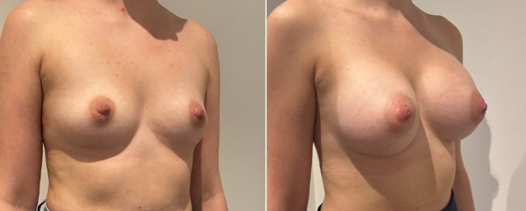 Augmentation mammoplasty surgery, before and after 220, angle view, BPCS Brisbane