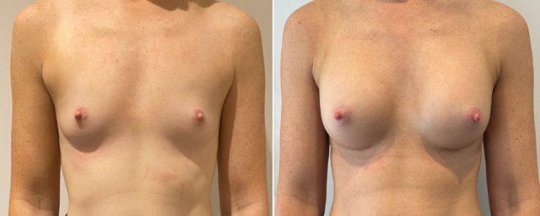 Augmentation mammoplasty surgery, before and after 221, front view, BPCS Brisbane