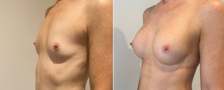 Augmentation mammoplasty surgery, before and after 221, angle view, BPCS Brisbane