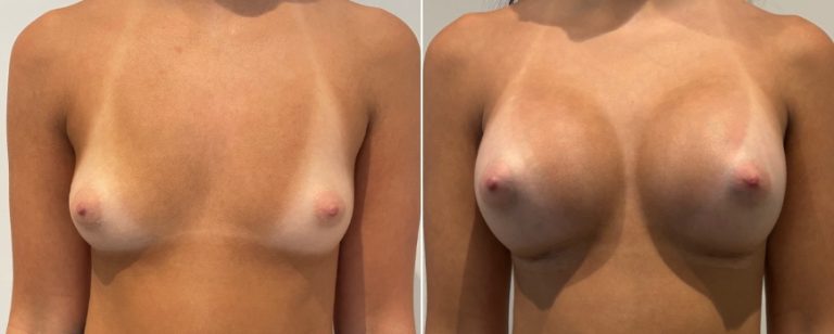 Augmentation mammoplasty surgery, before and after 222, front view, BPCS Brisbane