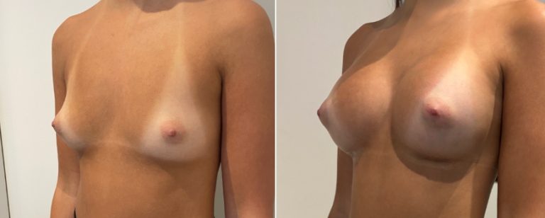 Augmentation mammoplasty surgery, before and after 222, angle view, BPCS Brisbane