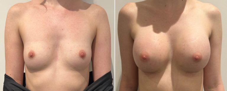 Augmentation mammoplasty surgery, before and after 223, front view, BPCS Brisbane