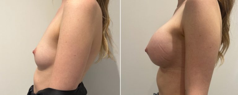 Augmentation mammoplasty surgery, before and after 223, side view, BPCS Brisbane