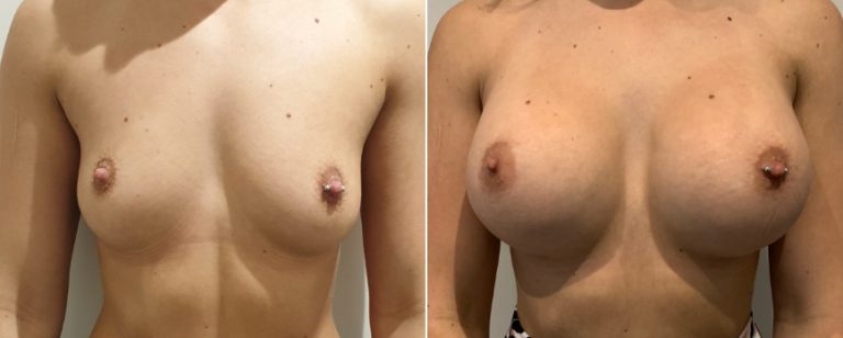 Breast augmentation (breast implants), before and after 224, front view, BPCS Brisbane, Dr Richardson
