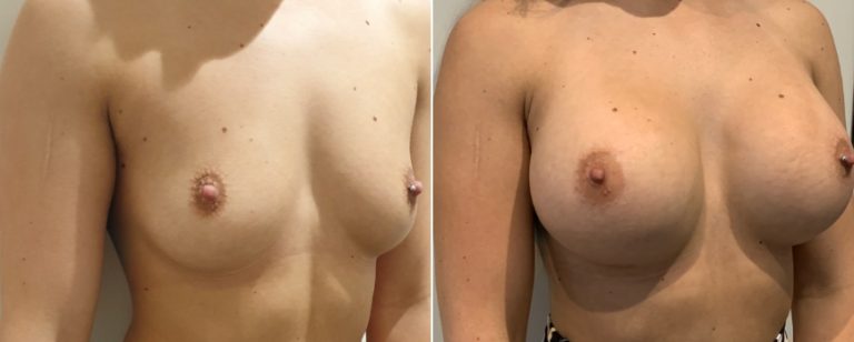 Breast augmentation (breast implants), before and after 224, angle view, BPCS Brisbane, Dr Richardson
