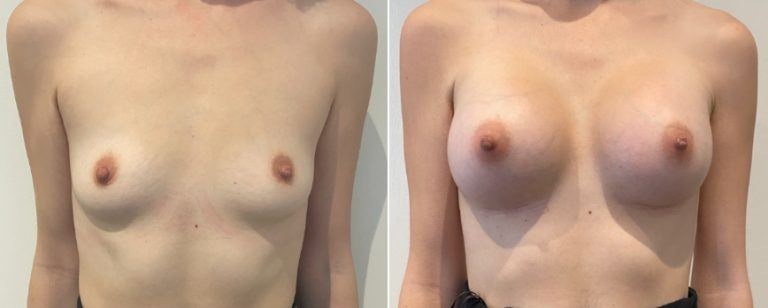 Breast augmentation (breast implants), before and after 225, front view, BPCS Brisbane, Dr Richardson