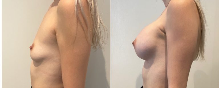Breast augmentation (breast implants), before and after 225, side view, BPCS Brisbane, Dr Richardson