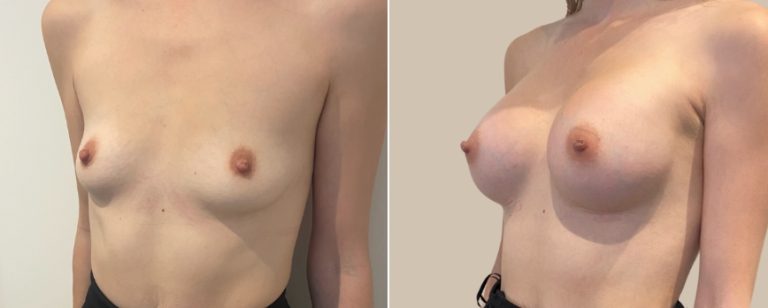 Breast augmentation (breast implants), before and after 225, angle view, BPCS Brisbane, Dr Richardson