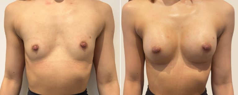 Breast augmentation (breast implants), before and after 226, front view, BPCS Brisbane, Dr Richardson