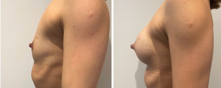 Breast augmentation (breast implants), before and after 226, side view, BPCS Brisbane, Dr Richardson