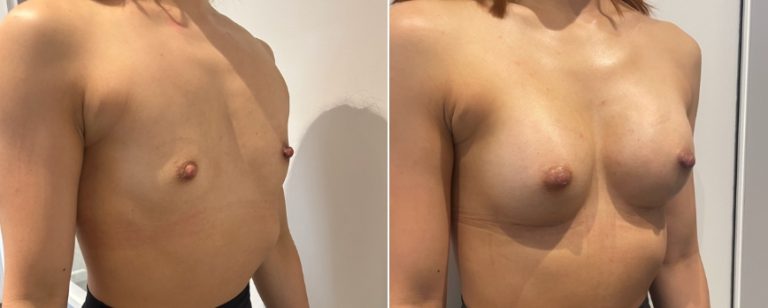 Breast augmentation (breast implants), before and after 226, angle view, BPCS Brisbane, Dr Richardson