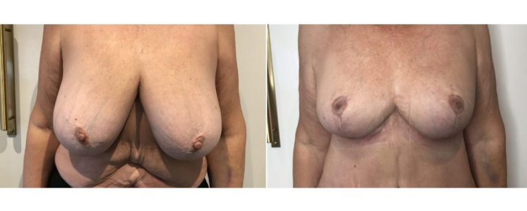 Breast reduction before and after 5, front view, BPCS Brisbane