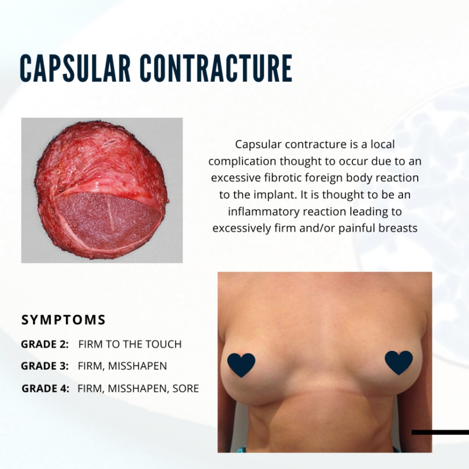 Breast Implant Rupture Explained 2 capsular contracture