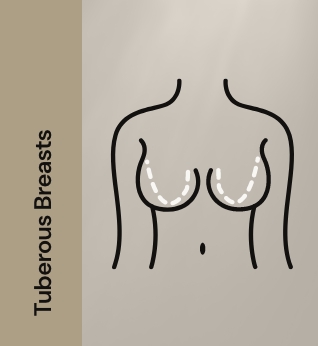 Tuberous breasts 11