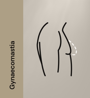 Gynaecomastia 11