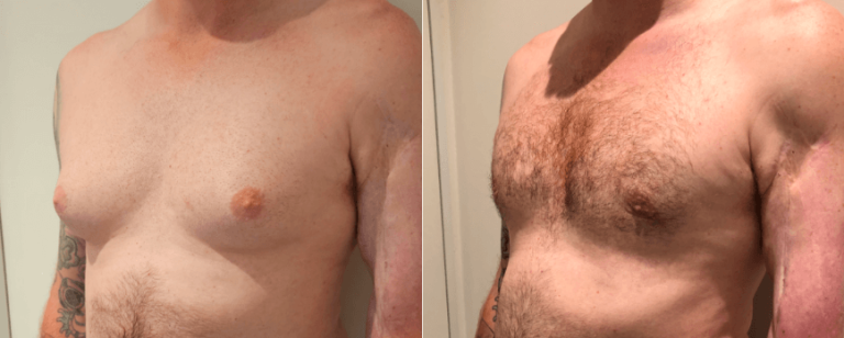 Male breast reduction before and after 2-1, angle view, Brisbane Plastic Surgery, QLD