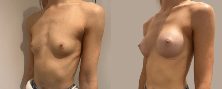 Breast Augmentation (breast implants), surgery results, before and after 2, angle view, BPCS Brisbane