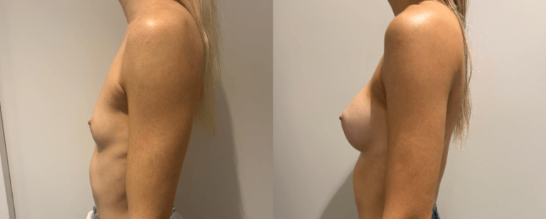 Breast Augmentation (breast implants), before and after 3, side view, BPCS Brisbane